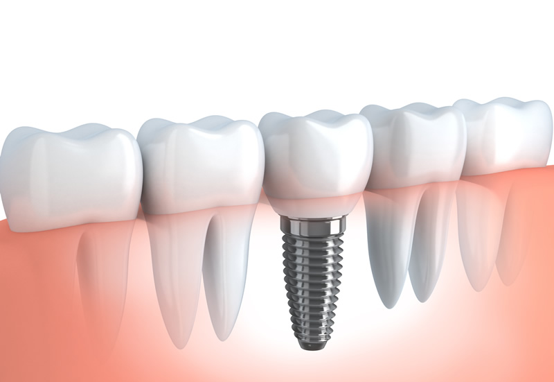 Implantati