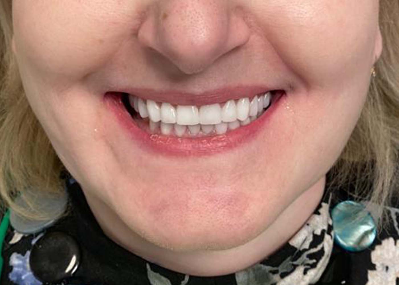 Dentelli Testimonials - E Forsyth After