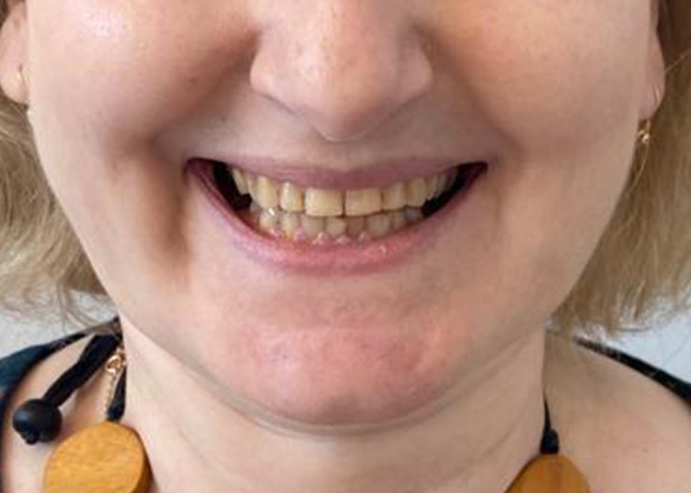 Dentelli Testimonials - E Forsyth Before